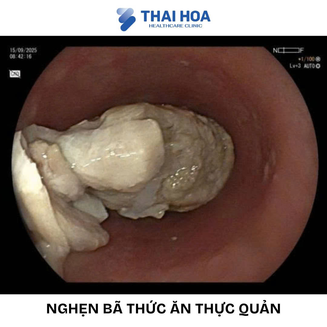 hinh-mac-nghen-ba-thuc-an.jpg